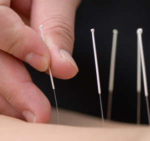 acupunctureimage.jpg